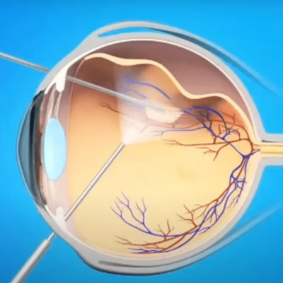 Chirurgie vitréo-rétiniène - Ophtalmologie du Saint Quentin 