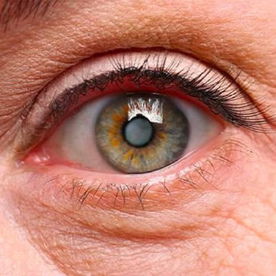 Ophtalmologie du Saint Quentin - Traitement de la Cataracte