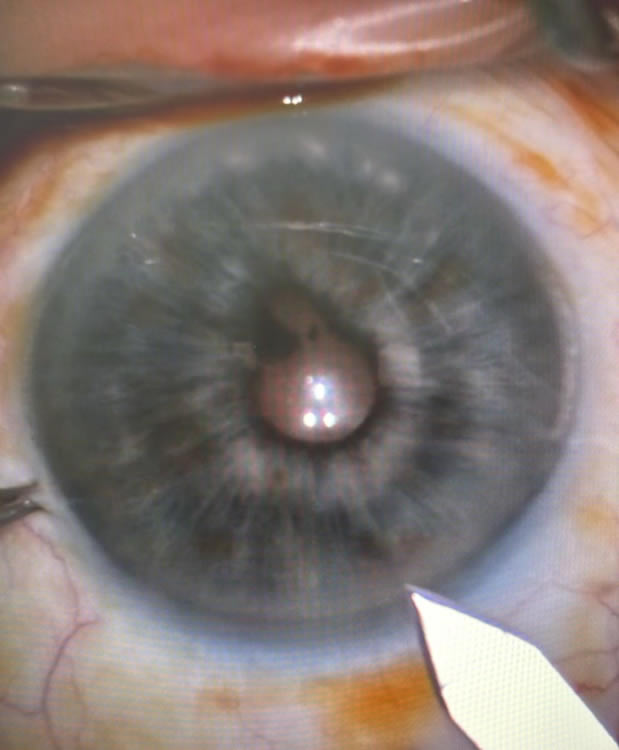 Soins Cataracte cabinet d'ophtalmologie du Saint Quentin