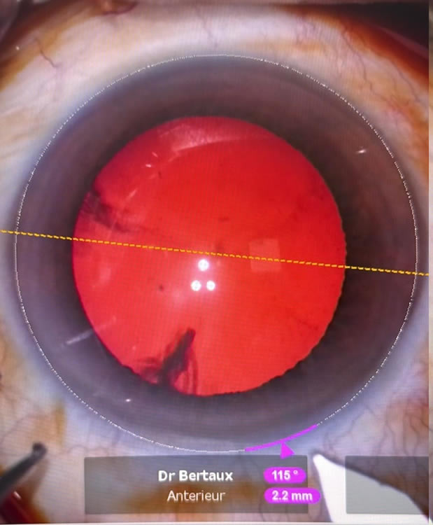 Soins Cataratce cabinet d'ophtalmologie du Saint Quentin