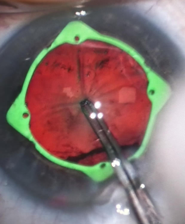 Soins Cataracte cabinet d'ophtalmologie du Saint Quentin