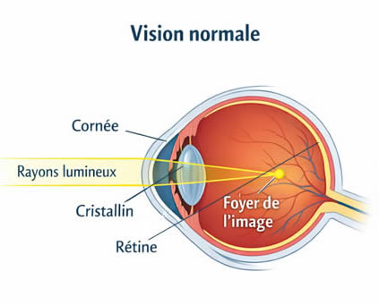 Vision Normale