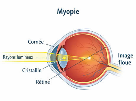 Myopie